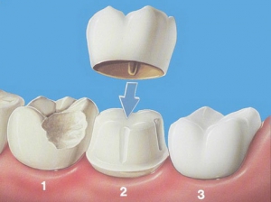 Les couronnes dentaires - Les implants dentaires du GEPI